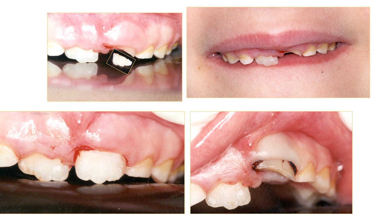טיפול בחבלות בשיניים אצל ד"ר מלכה אשכנזי