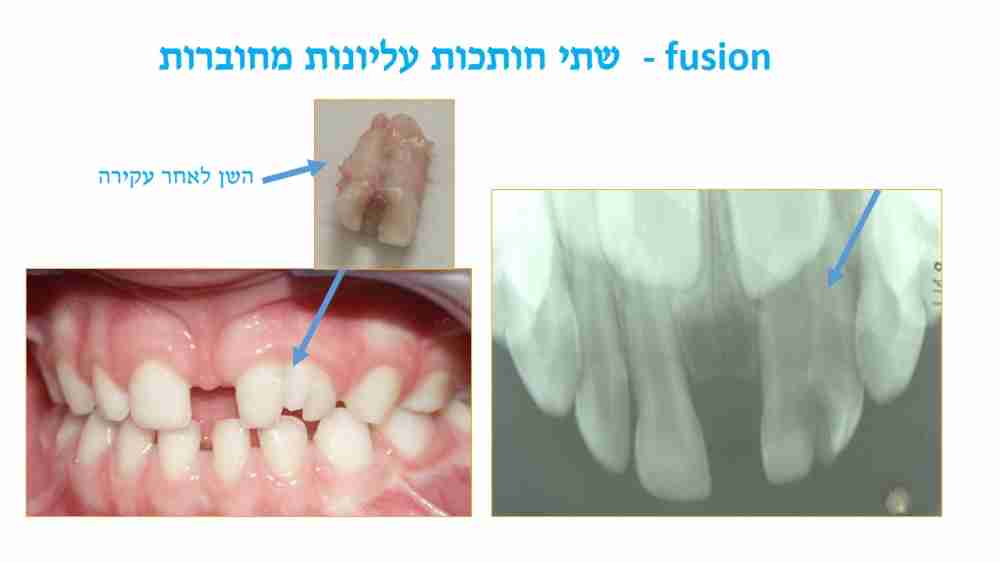 הפרעות בגודל השיניים אצל ילדים - שתי חותכות מחוברות - דר מלכה אשכנזי