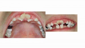 הפרעות בנשירת שיניים אצל ילדים - דר מלכה אשכנזי -1