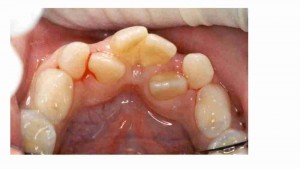 הפרעות צפיפות שיניים אצל ילדים - דר מלכה אשכנזי