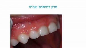 חבלות בפה אצל ילדים - סדק בחותכת - דר מלכה אשכנזי 