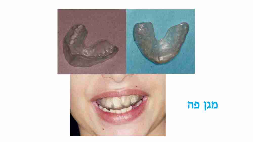 מניעת חבלות בשיניים לילדים - מגן פה - דר מלכה אשכנזי 