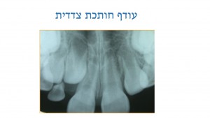 עודף שיניים אצל ילדים - עודף חותכת - דר מלכה אשכנזי