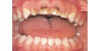 עששת הגיל הרך - דר מלכה אשכנזי מומחית טיפול שיניים לילדים