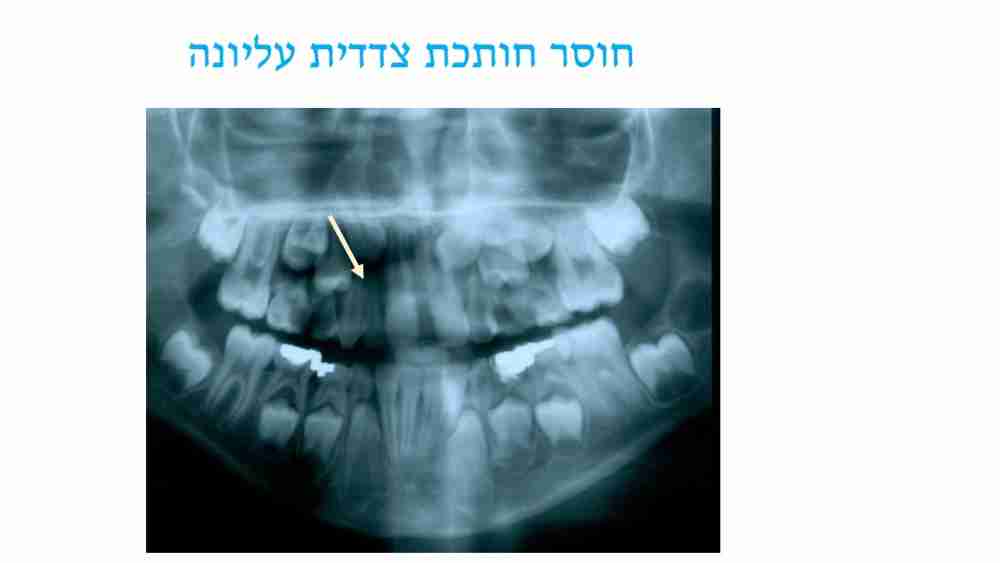 הפרעות במספר השיניים אצל ילדים - חוסר חותכת - דר מלכה אשכנזי