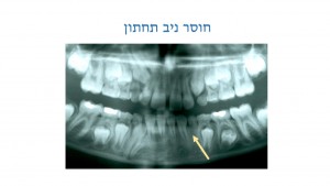 הפרעות במספר השיניים אצל ילדים - חוסר ניב - דר מלכה אשכנזי