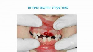 הפרעות בנשירת שיניים אצל ילדים - דר מלכה אשכנזי - 2