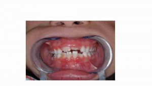 מחלות חניכיים (פריודונטליות) - דר מלכה אשכנזי מומחית טיפול שיניים לילדים