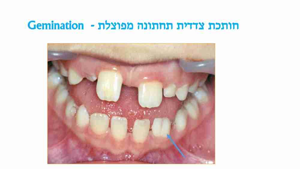 הפרעות בגודל השיניים אצל ילדים - חותכת מפוצלת - דר מלכה אשכנזי
