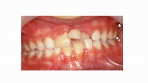 הפרעות בנשירת שיניים אצל ילדים - דר מלכה אשכנזי - 3