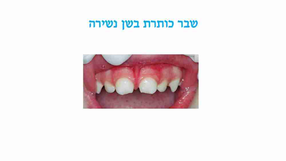 חבלות בפה אצל ילדים - שבר כותרת - דר מלכה אשכנזי 