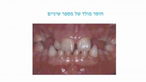 הפרעות במספר השיניים אצל ילדים - חוסר מולד - דר מלכה אשכנזי
