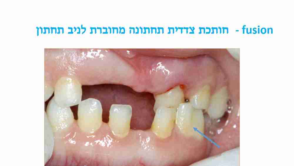 הפרעות בגודל השיניים אצל ילדים - חותכת תחתונה מחוברת - דר מלכה אשכנזי