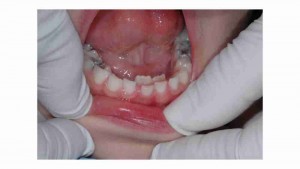הפרעות בנשירת שיניים אצל ילדים - דר מלכה אשכנזי - 4 