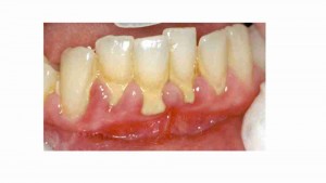 מחלות חניכיים (פריודונטליות) - דר מלכה אשכנזי מומחית טיפול שיניים לילדים