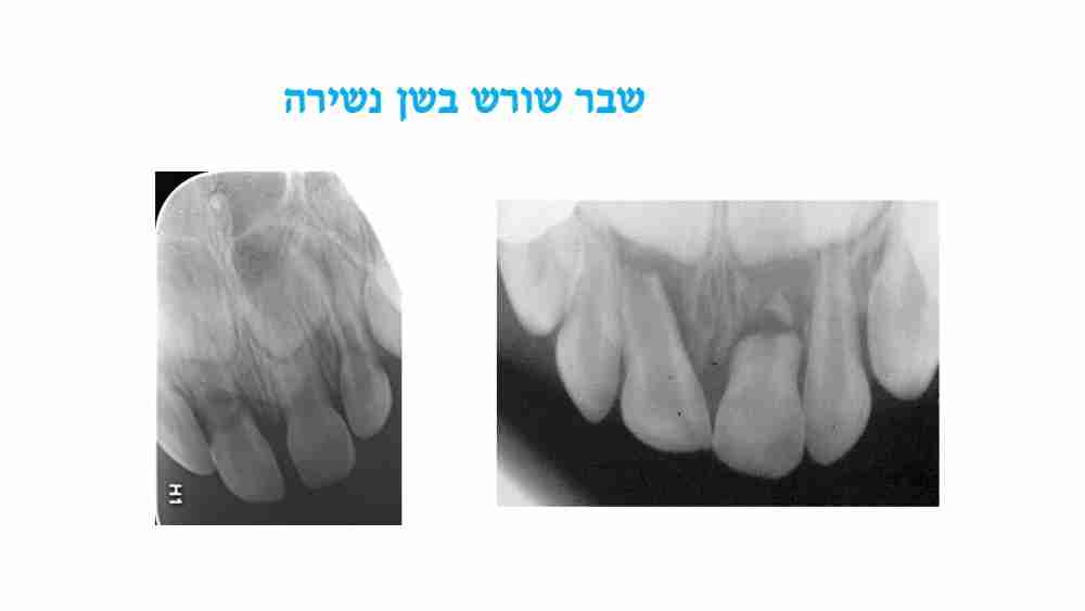 חבלות בפה אצל ילדים - שבר שורש - דר מלכה אשכנזי 