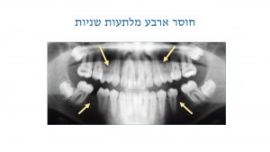 טיפול שיניים בתינוקות - חוסר מלתעות - דר מלכה אשכנזי